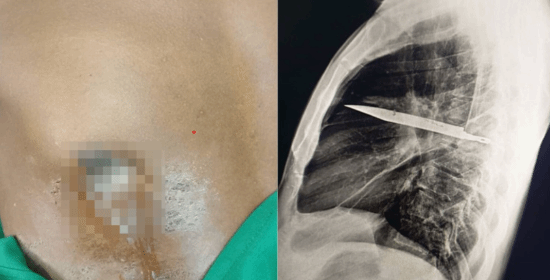 男子胸部流膿 X光發(fā)現(xiàn)刀留體內(nèi)8年:剛好避開心臟血管
